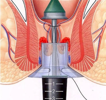 stapler surgery in pune