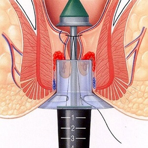 Stapler surgery for piles at Good Morning piles hospital in Pune